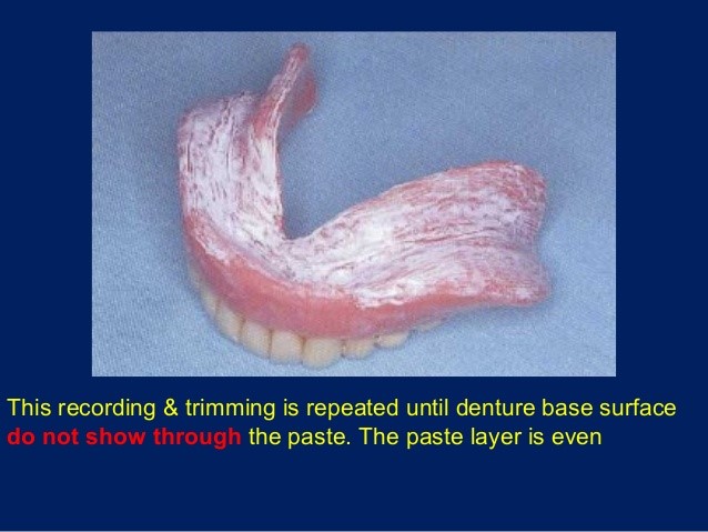 Immediate Dentures Procedure Newton MS 39345